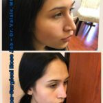 Refine Your Look with a Liquid Nose Job in Orange County – Trusted Medspa Services