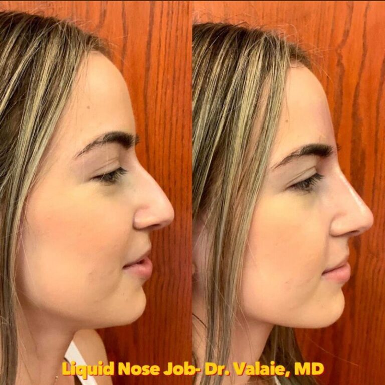 liquid nose job (10)
