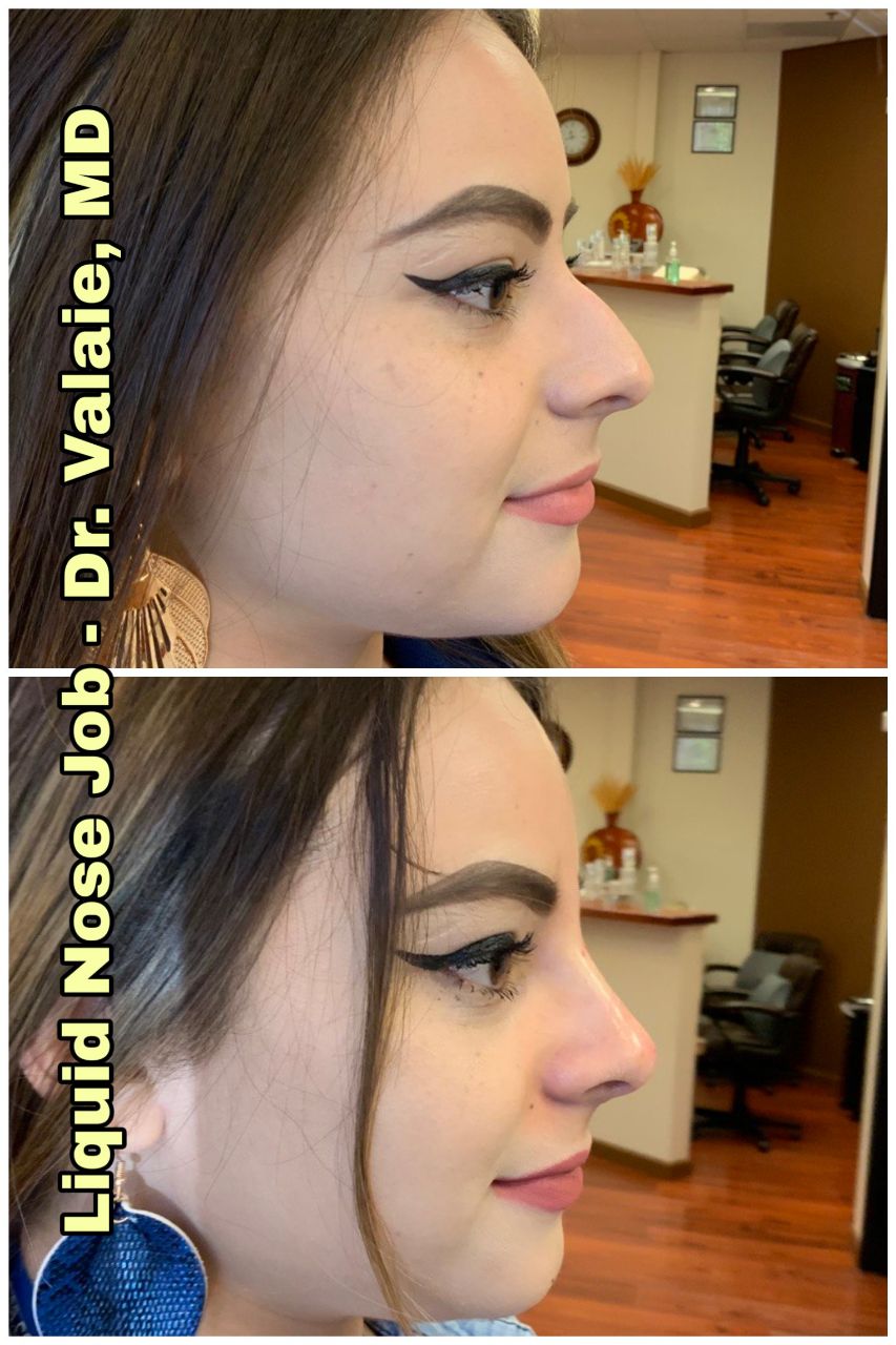 liquid nose job (100)