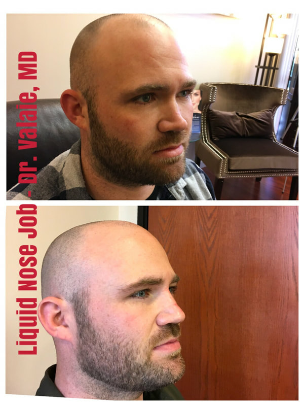 liquid nose job (107)