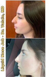 liquid nose job