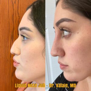 liquid nose job