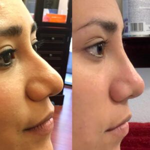 liquid nose job females