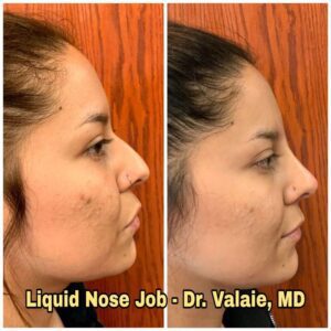 liquid nosepin job