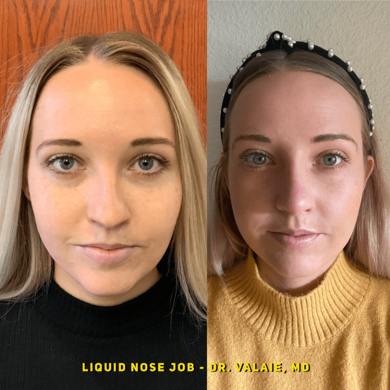liquid nose job (12)