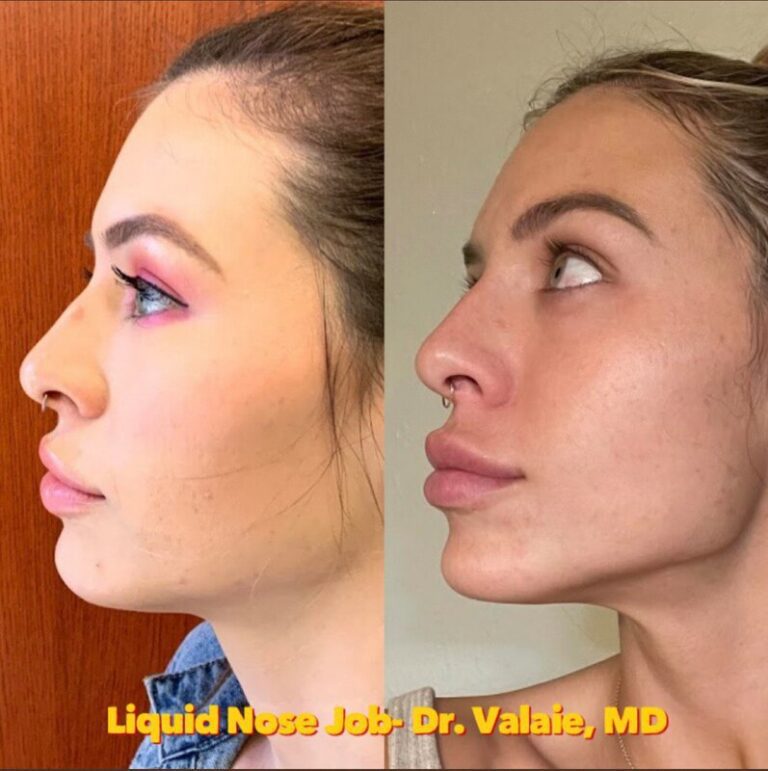 liquid nose job (12)