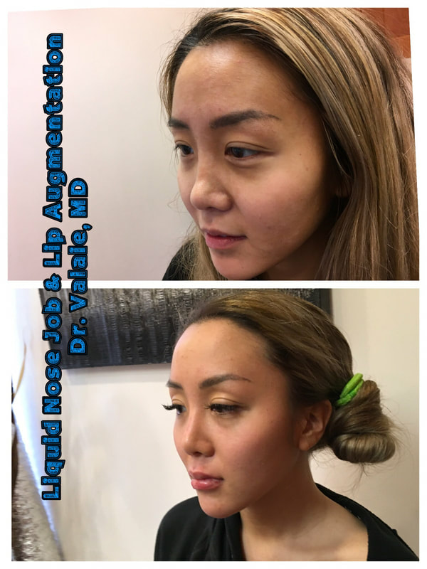 liquid nose job & lip