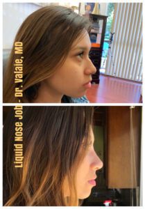 liquid nose job MD