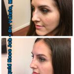 How to Care for Your Nose After a Non Surgical Nose Job