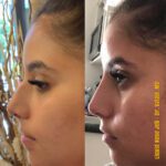 What Is Non Surgical Rhinoplasty and How Does It Work? 