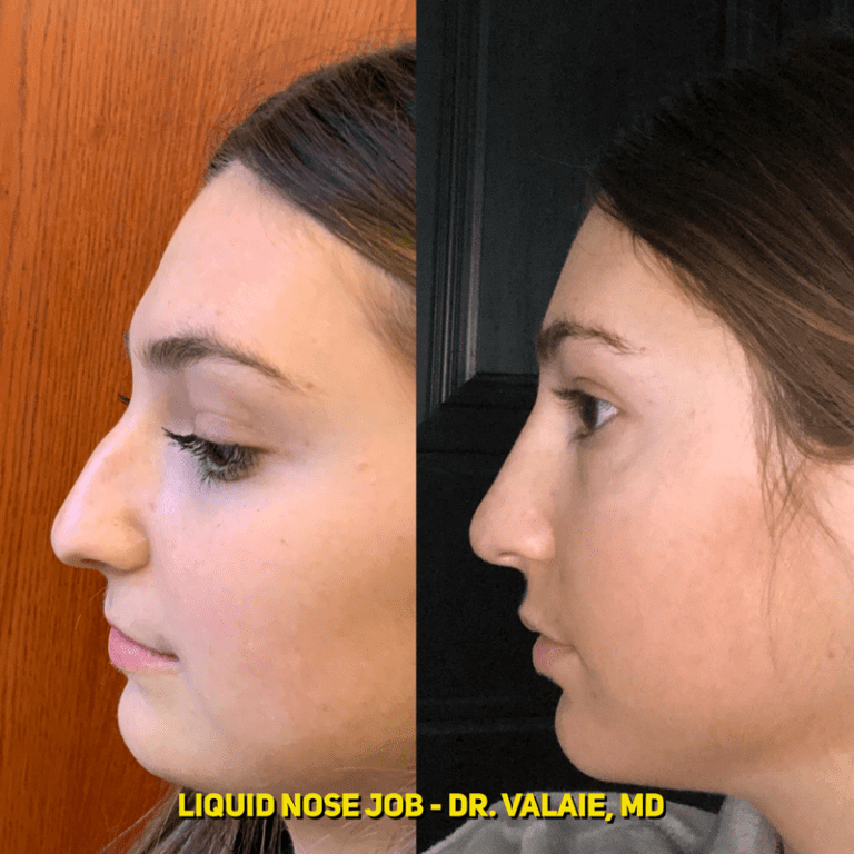 liquid nose job (18)