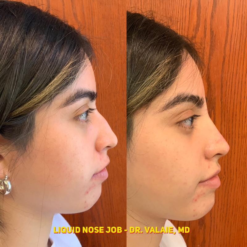 liquid nose job (20)