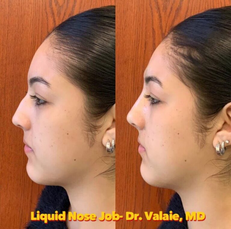 liquid nose job