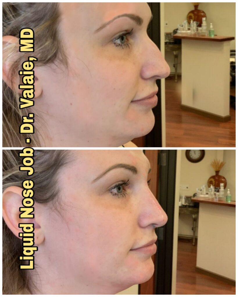 liquid nose job (37)