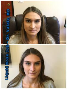 liquid nose job (77)