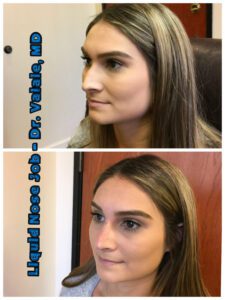 liquid nose job (78)