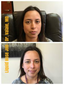 liquid nose job (79)