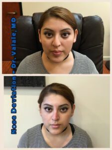 liquid nose job (82)