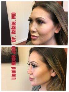 liquid nose job (87)