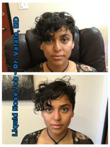 liquid nose job (90)