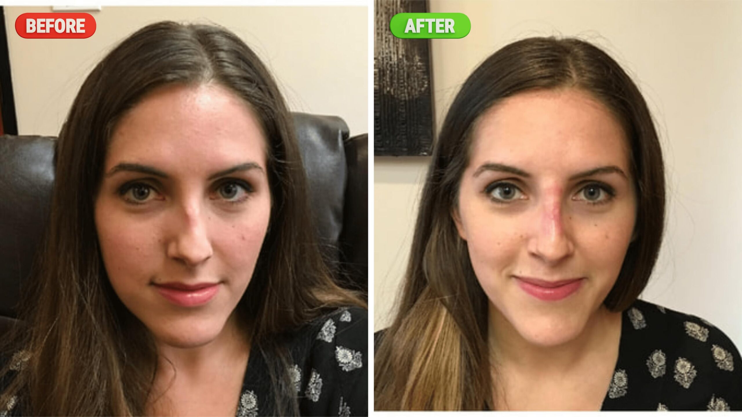 Liquid Nose Job