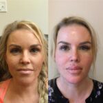 Dark Circles? Learn About Tear Trough Eye Treatment