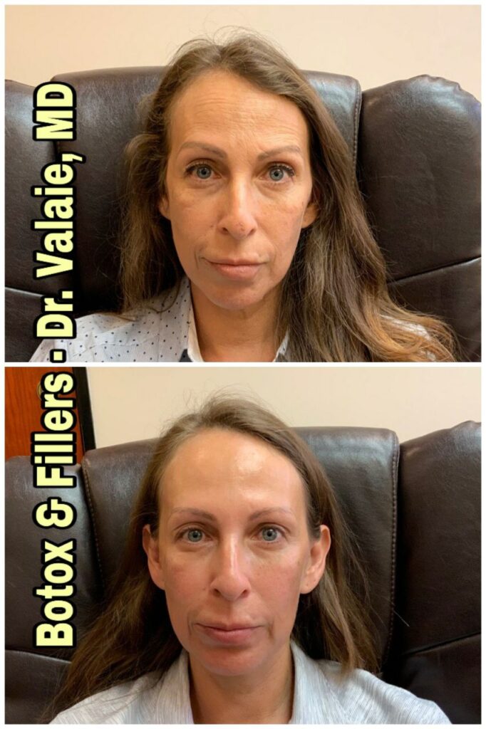 Botox Treatment 3