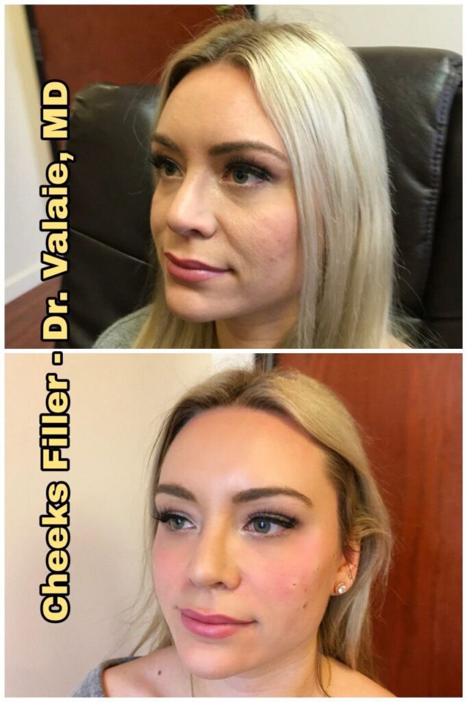 CHEEK AUGMENTATION (1)