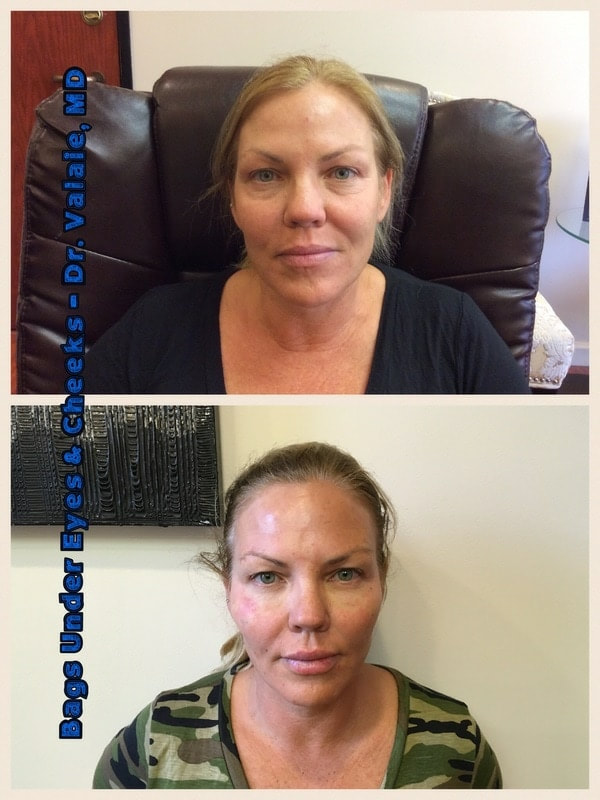 CHEEK AUGMENTATION (11)