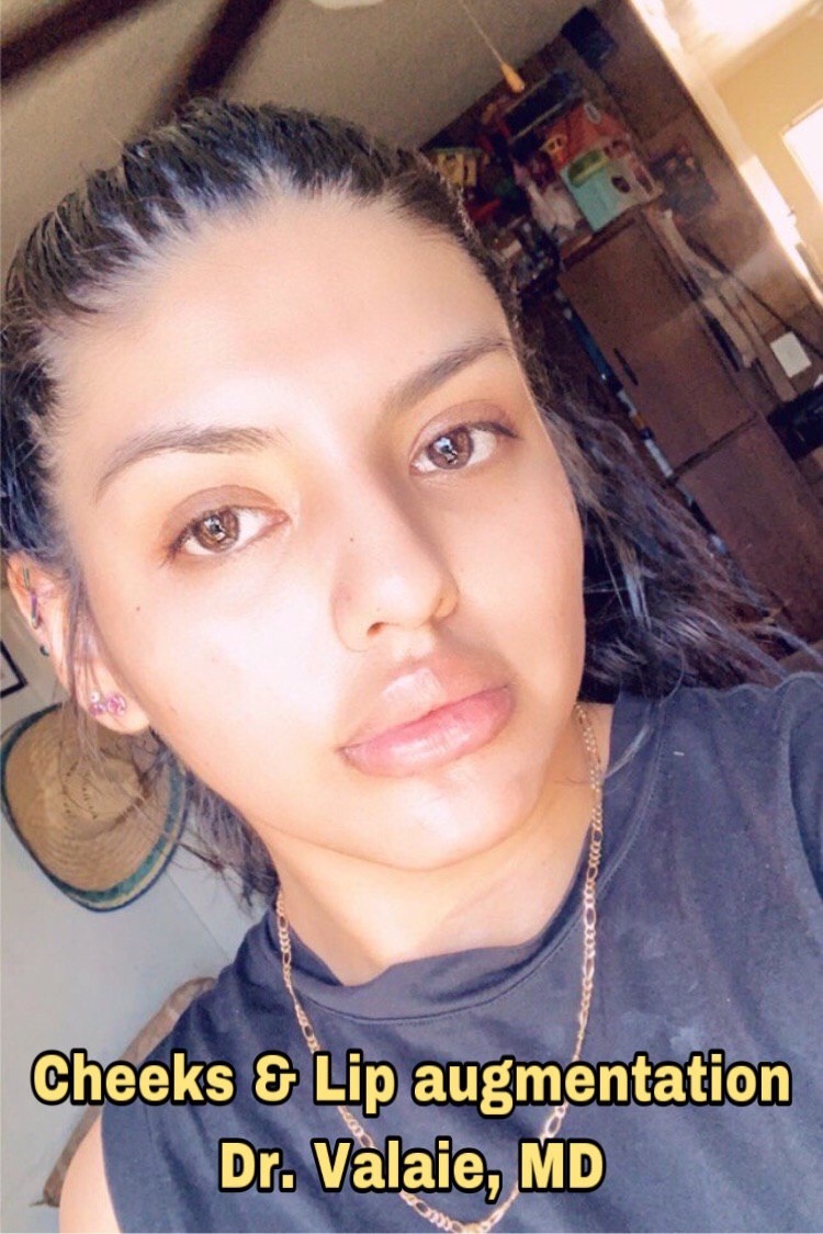 CHEEK AUGMENTATION (7)