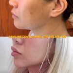 Turn Back Time with Jawline Contouring Treatments