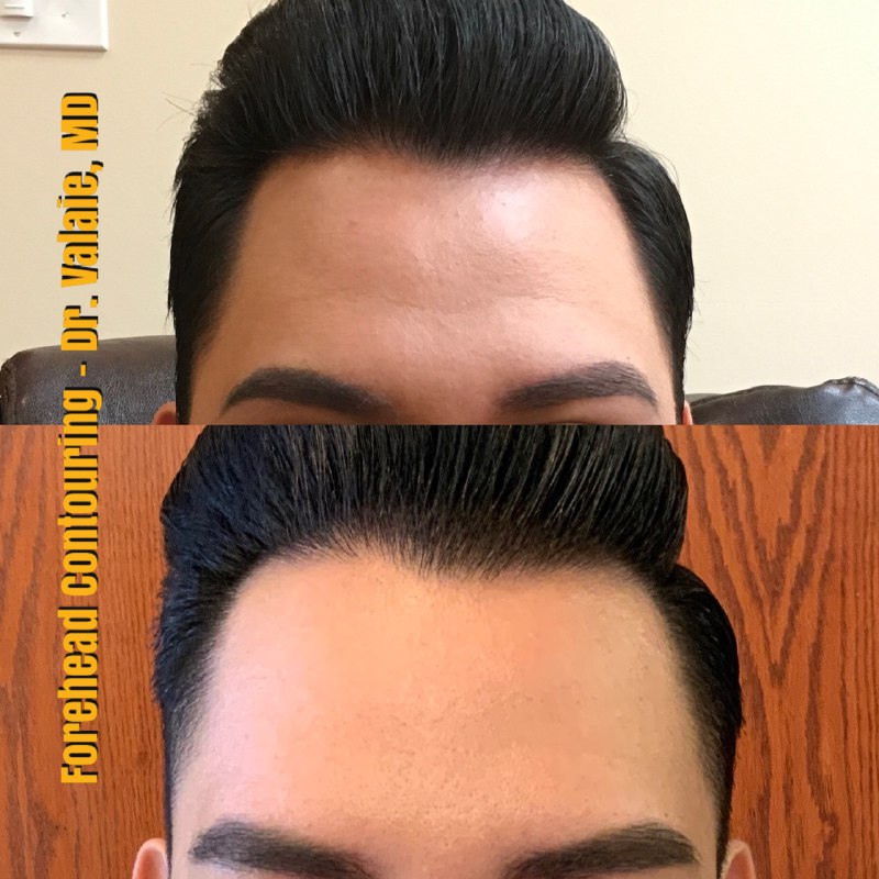 FOREHEAD CONTOURING (2)