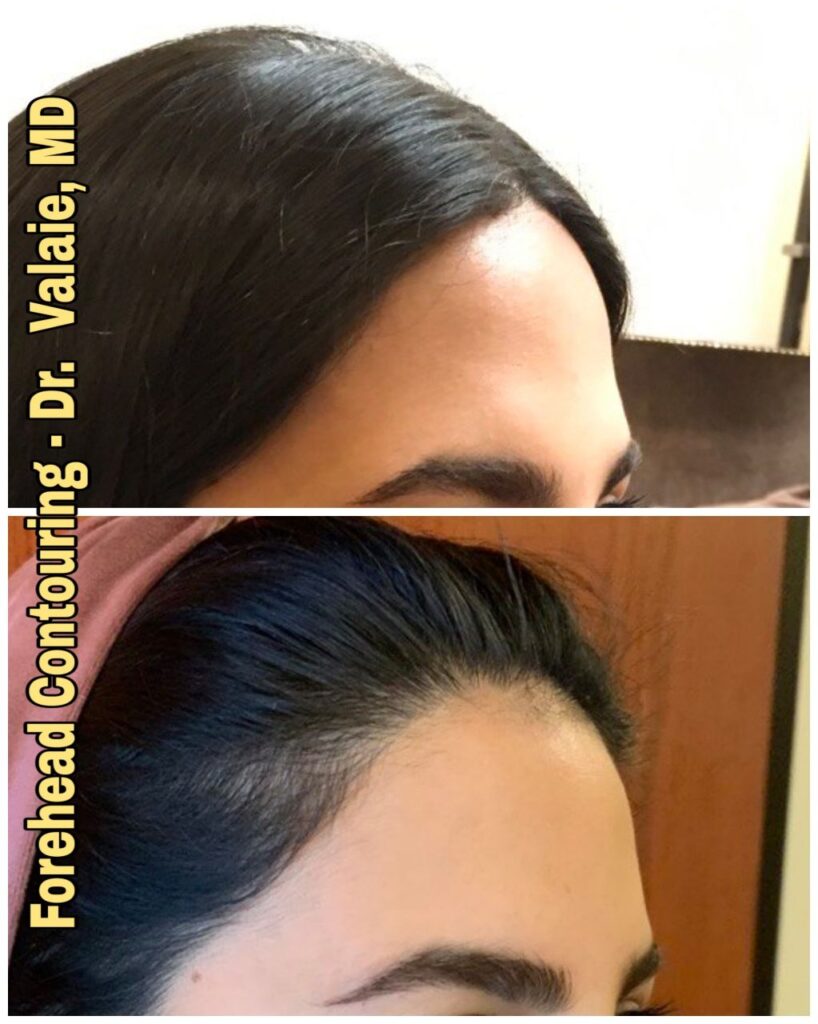 FOREHEAD CONTOURING