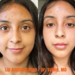 Lip Augmentation Orange County: What Should I Expect? 