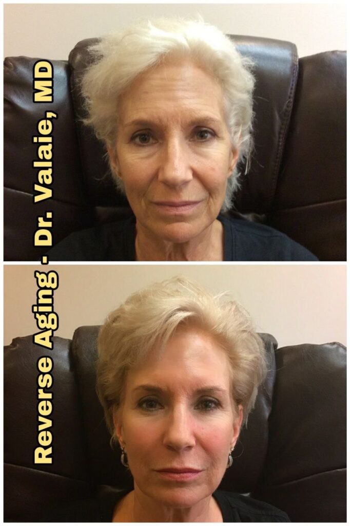 Reverse Aging (3)