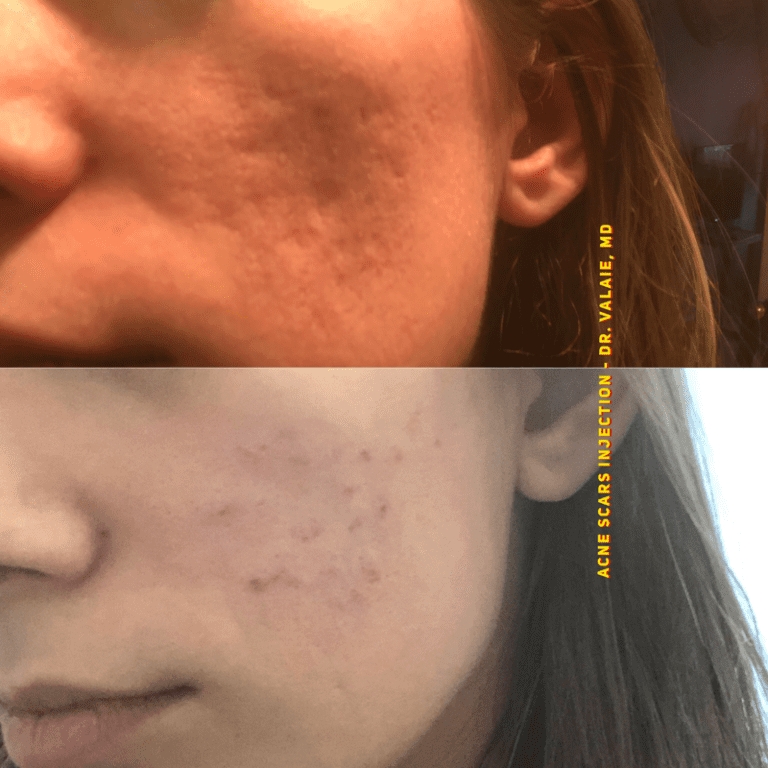 SCARS & ACNE SCARS INJECTION (1)