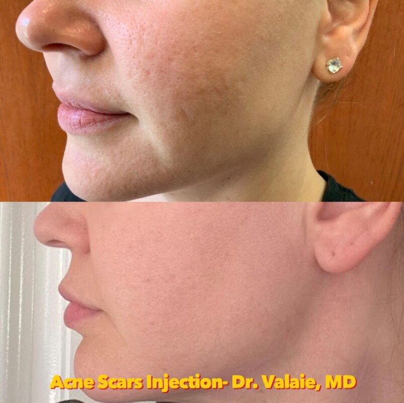SCARS & ACNE SCARS INJECTION (1)