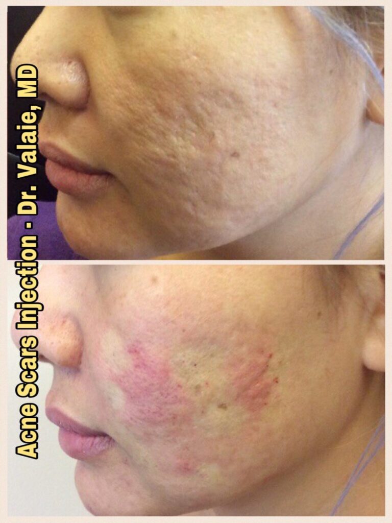 ACNE SCARS INJECTION (14)