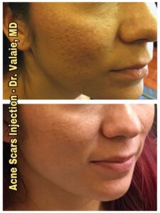 ACNE SCARS INJECTION (15)