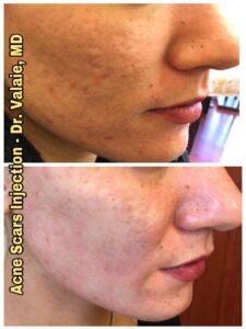 ACNE SCARS INJECTION (16)