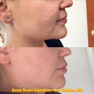 The Role of Collagen in Healing Acne Scars and Promoting Skin Health 