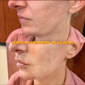 SCARS & ACNE SCARS INJECTION (20)