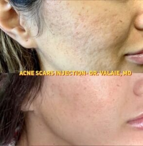 SCARS & ACNE SCARS INJECTION (23)