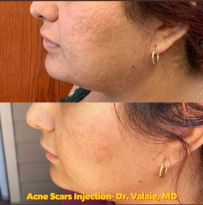 SCARS & ACNE SCARS INJECTION (26)