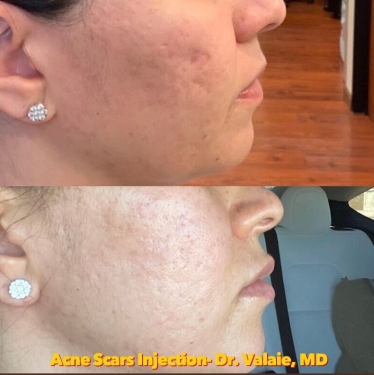 SCARS & ACNE SCARS INJECTION (27)
