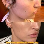 Scar Filler Treatment: Say Goodbye to Acne Scars 