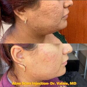 SCARS & ACNE SCARS INJECTION (3)