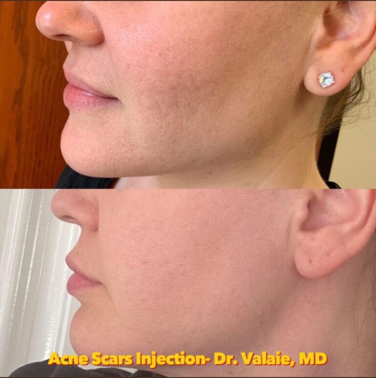 SCARS & ACNE SCARS INJECTION (30)