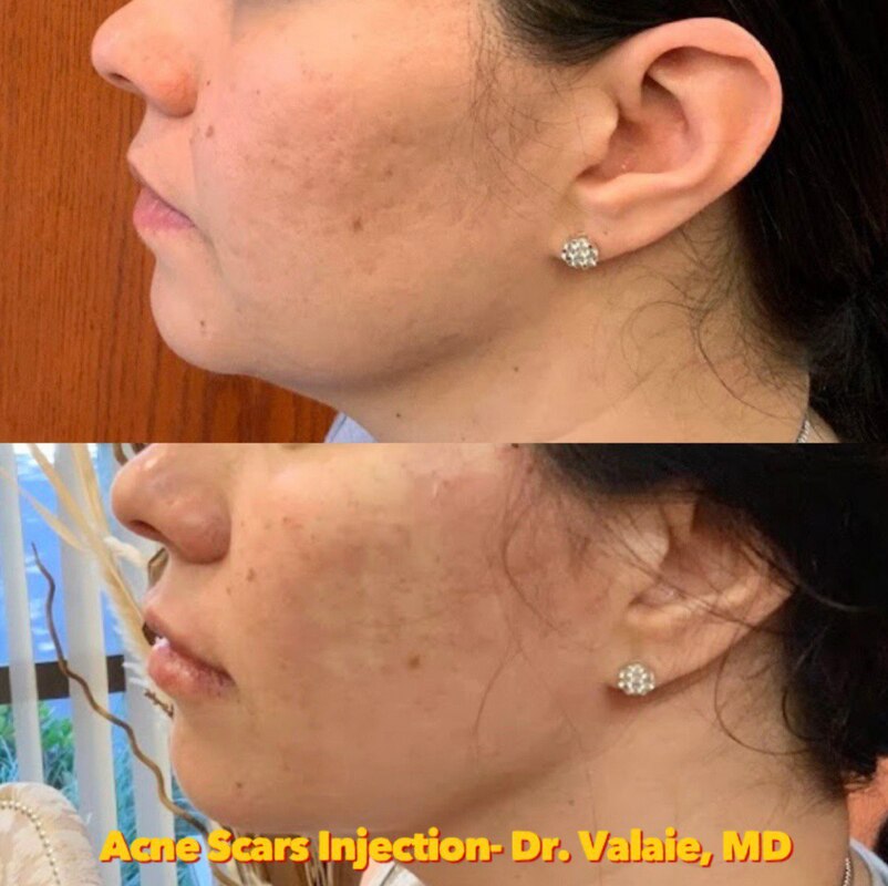 SCARS & ACNE SCARS INJECTION (7)