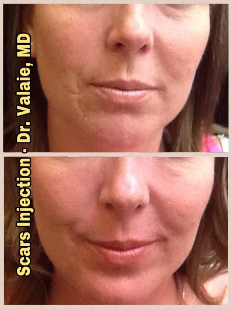 SCARS & ACNE SCARS INJECTION (9)